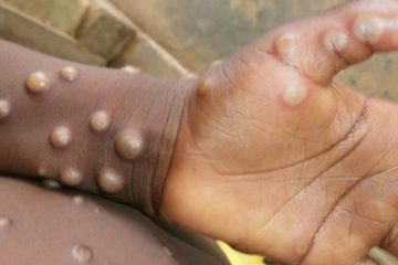 Les cas de «variole du singe» se multiplient en Europe et en Amérique du Nord
