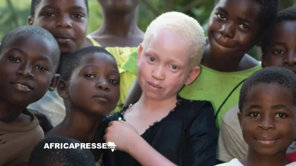 Albinos