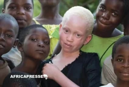 Journée mondiale de l’albinisme : le combat pour la vie, la justice et la reconnaissance continue