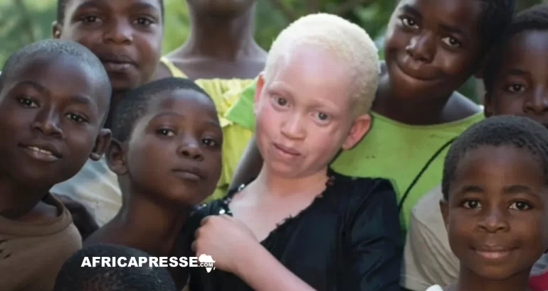 Albinos