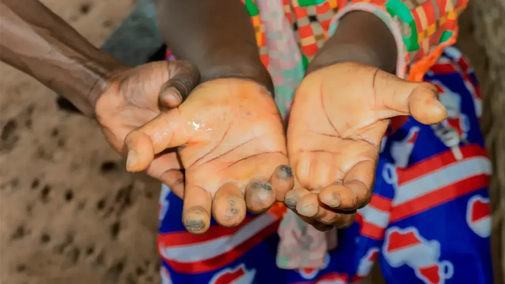 Afrique du Sud et OMS unissent leurs forces contre le fléau silencieux des maladies tropicales négligées