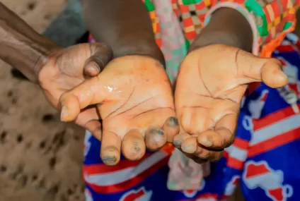 Afrique du Sud et OMS unissent leurs forces contre le fléau silencieux des maladies tropicales négligées