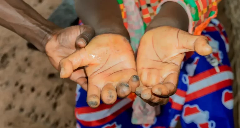 Afrique du Sud et OMS unissent leurs forces contre le fléau silencieux des maladies tropicales négligées