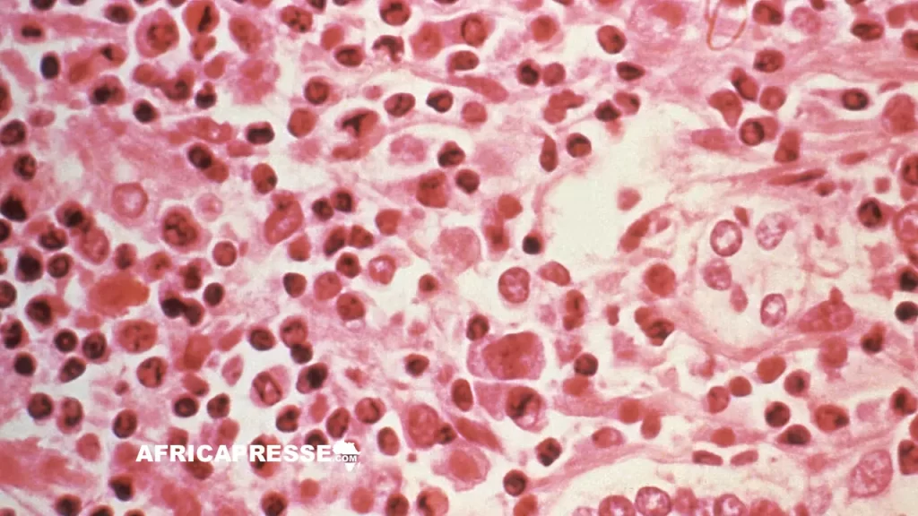 Hantavirus