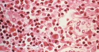 Hantavirus : le CDC Afrique en état d’alerte après trois morts à bord d’un navire de croisière
