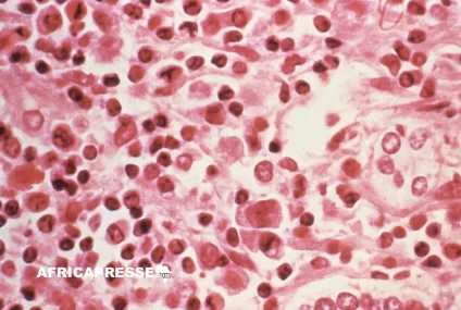 Hantavirus : le CDC Afrique en état d’alerte après trois morts à bord d’un navire de croisière