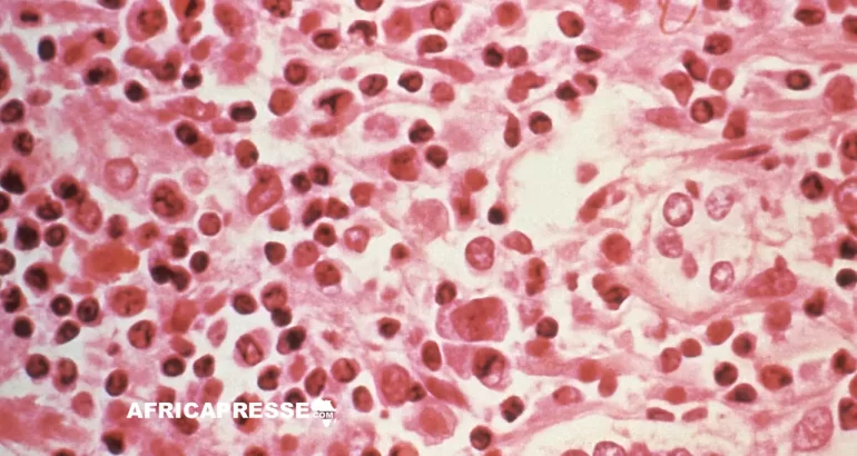 Hantavirus : le CDC Afrique en état d’alerte après trois morts à bord d’un navire de croisière
